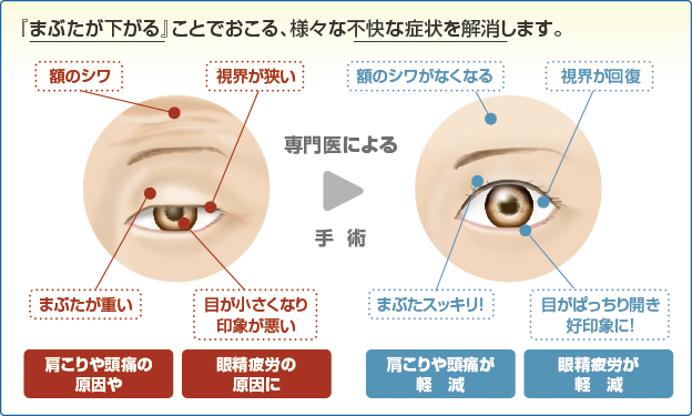 眼瞼下垂 治療・手術