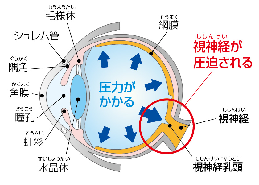 緑内障を治療しないとどうなりますか?