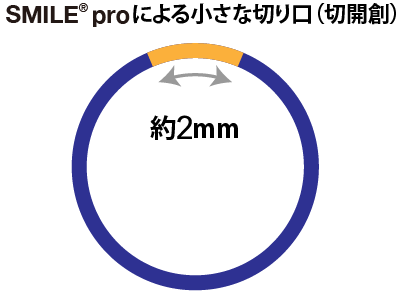 SMILE proによる小さな切り口（切開創）