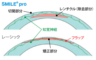 小さな切り口のため痛み・ドライアイが少ない。